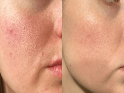 Closeup of a woman's glowing skin after facial